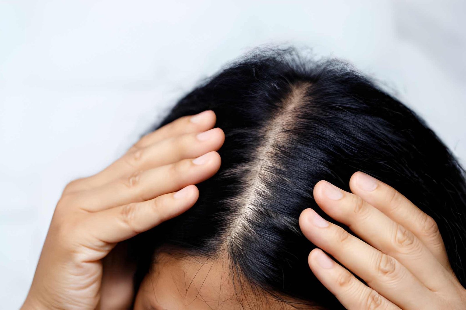 Telogen effluvium causing diffuse female hair shedding