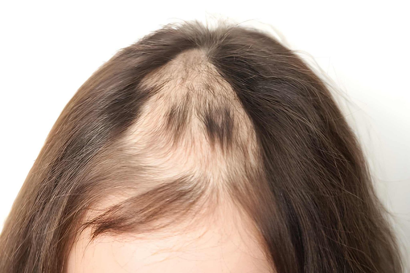Traction alopecia caused by repeated hair tension