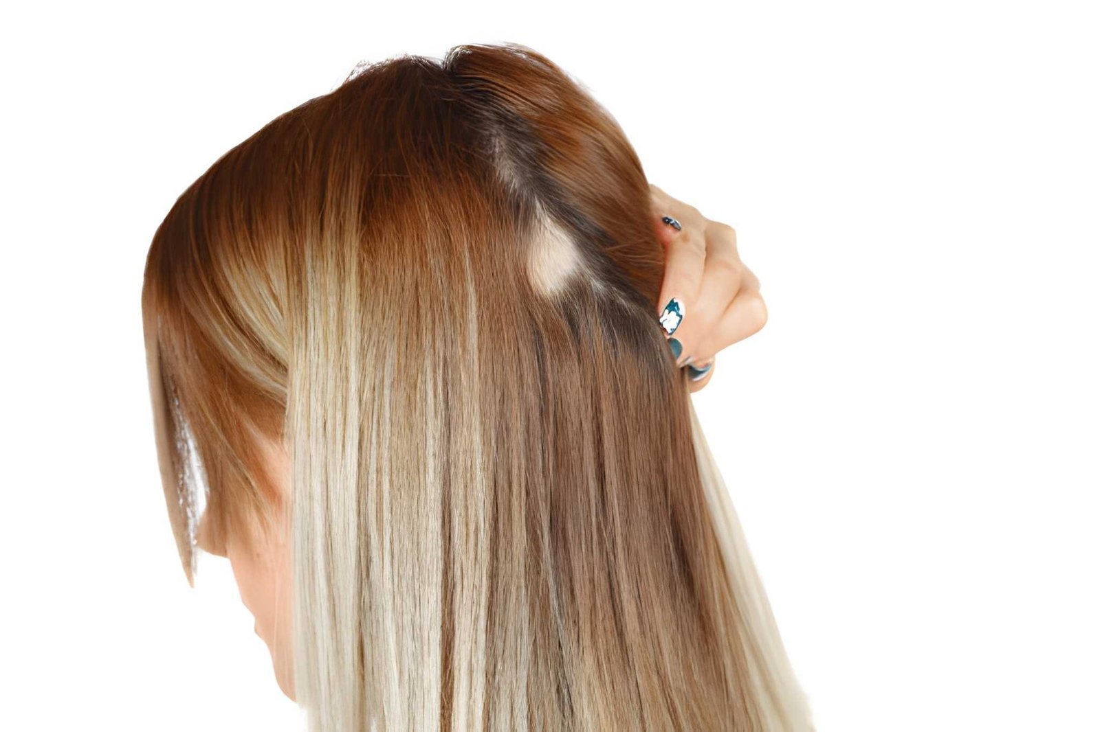 Traction alopecia caused by repeated tension on the hairline