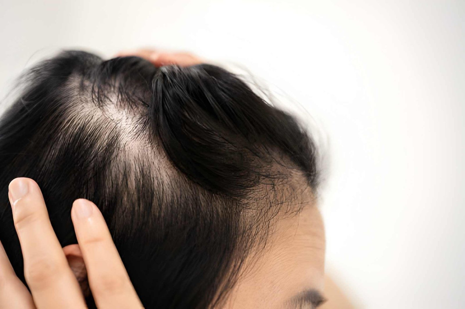 What Is Female Hair Loss