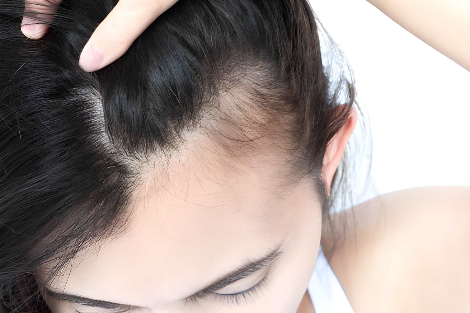 Widening part and crown thinning in female pattern hair loss
