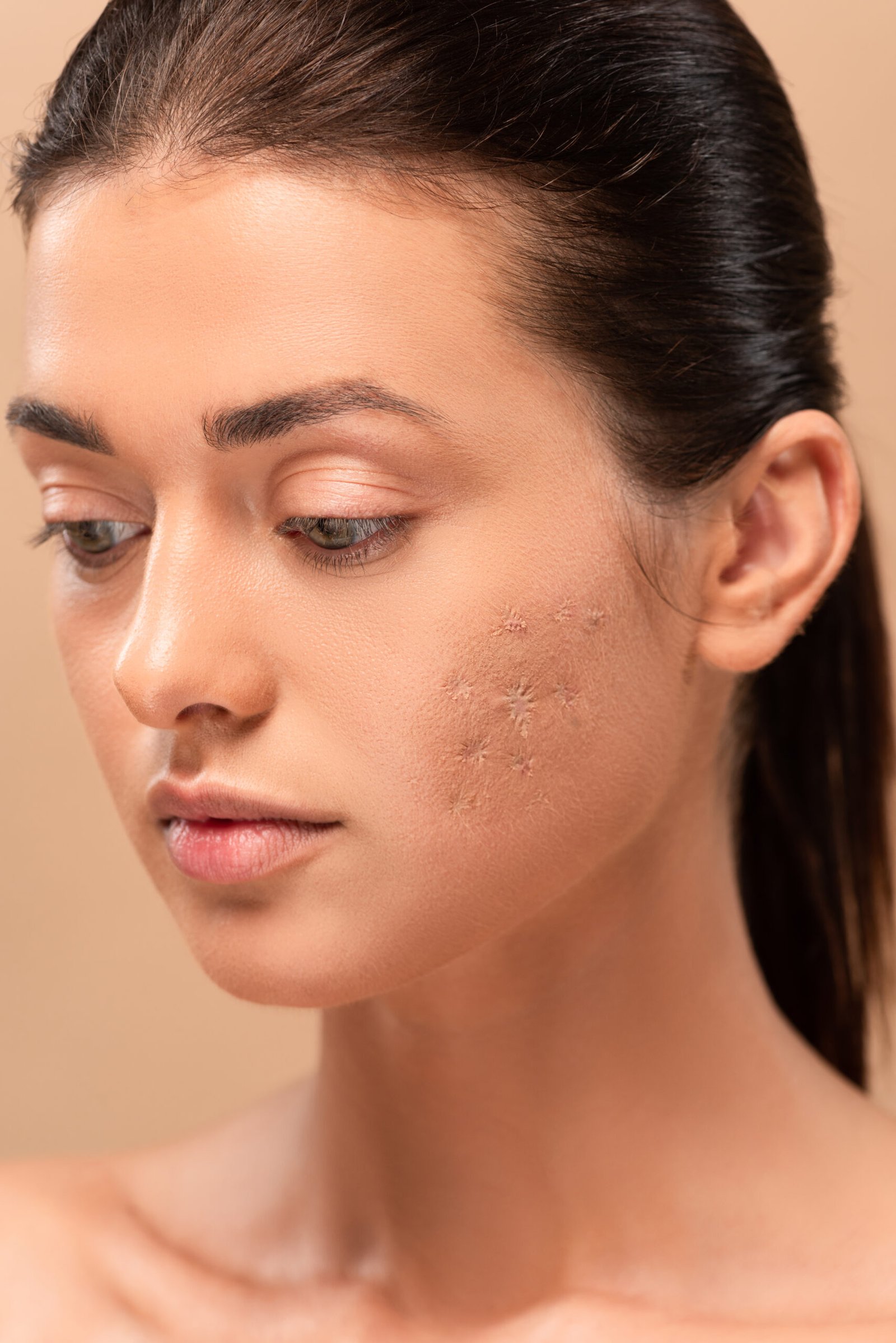 Acne scar treatment by Dr. Vijay Soyal, dermatologist in Delhi