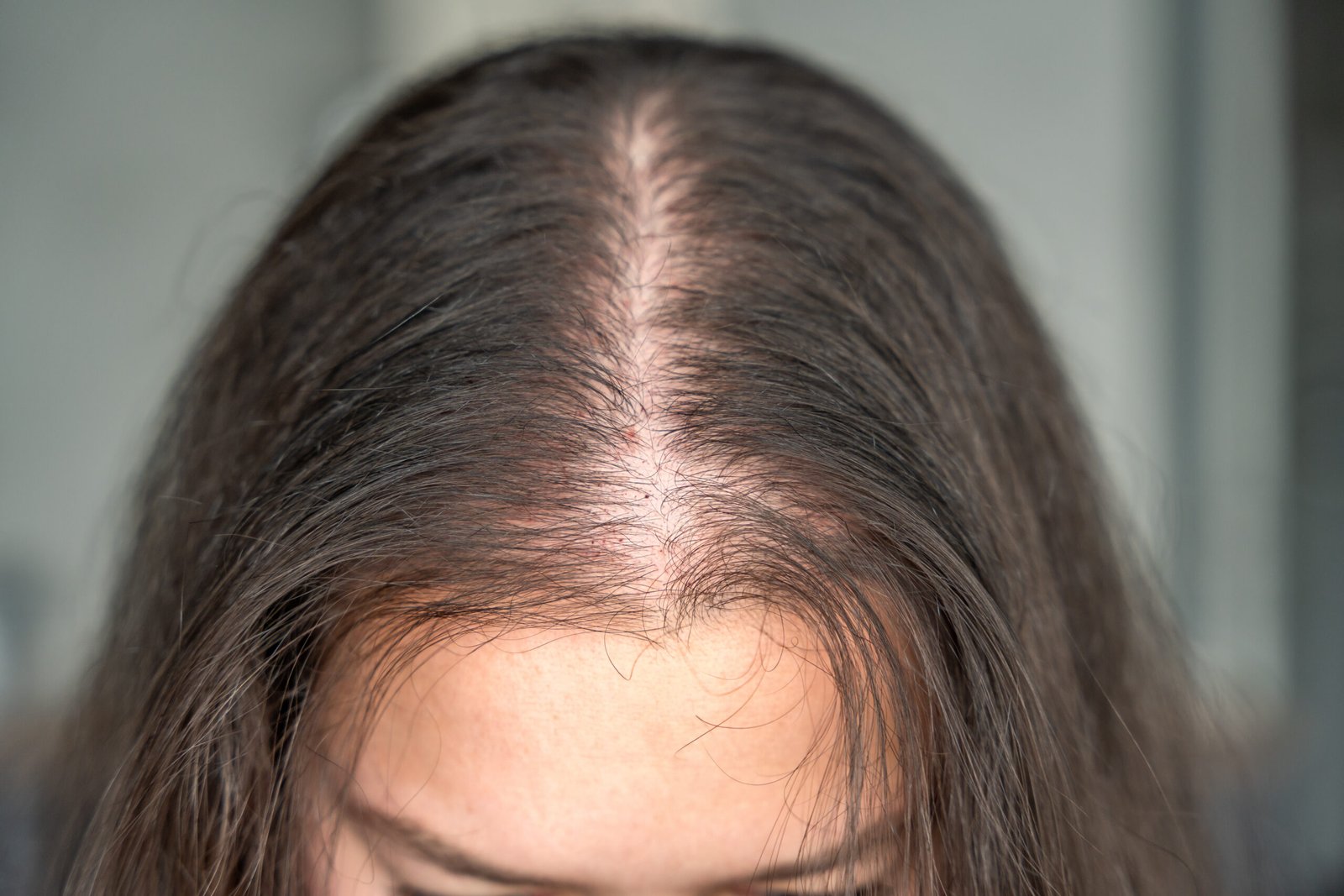 Early to moderate hair thinning suitable for GFC hair treatment
