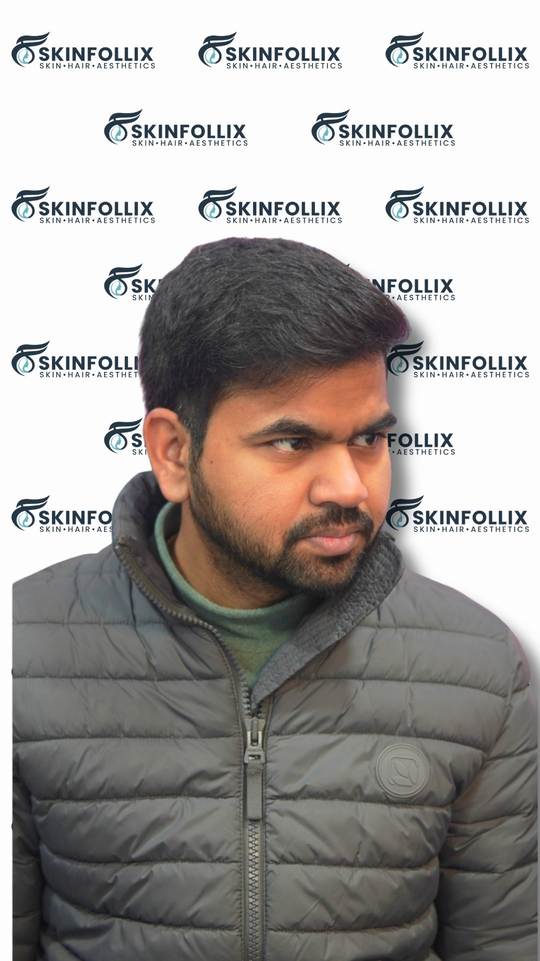 After hair regrowth treatment at Skinfollix in Delhi
