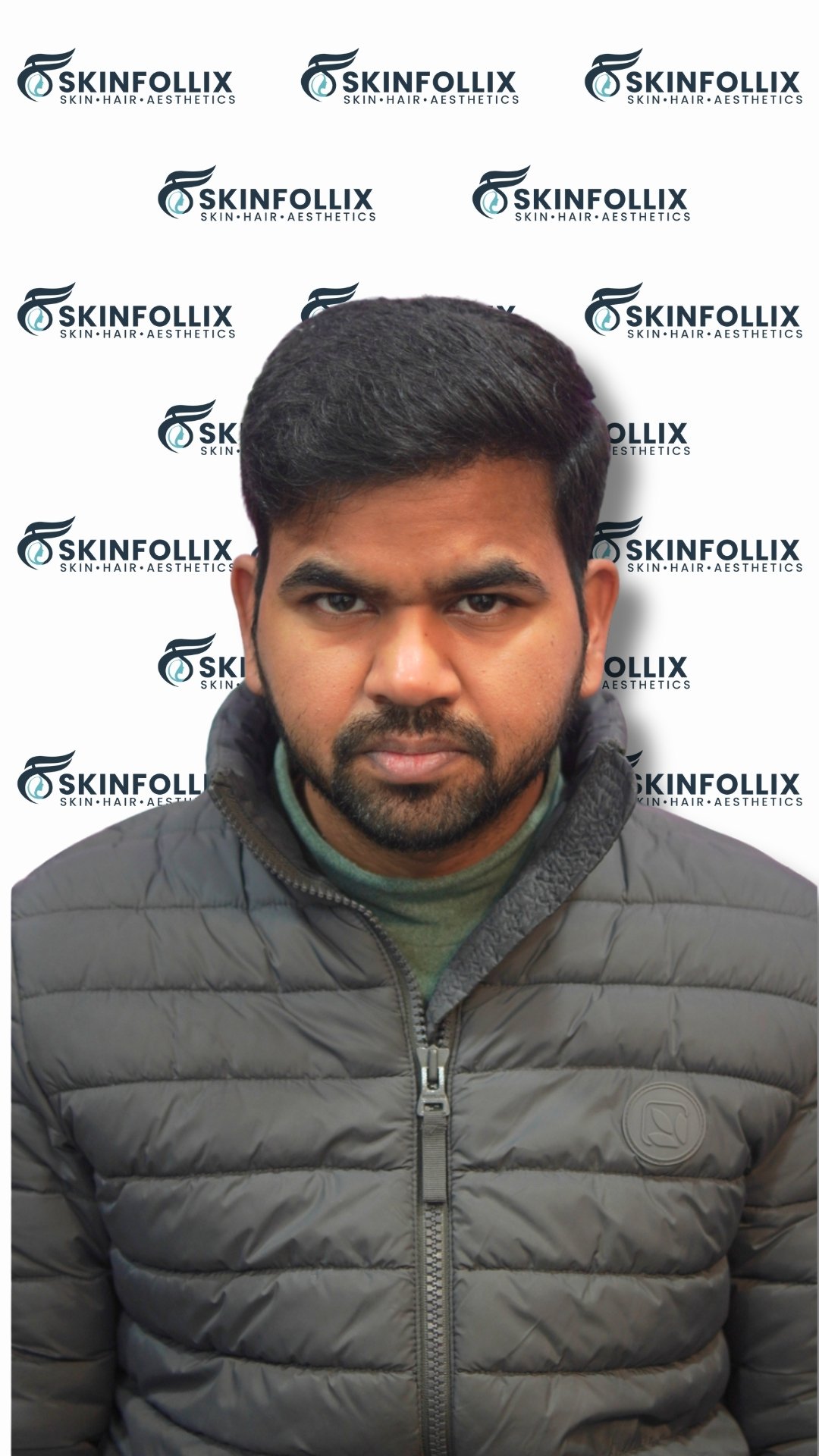 After hair regrowth treatment at Skinfollix in Delhi
