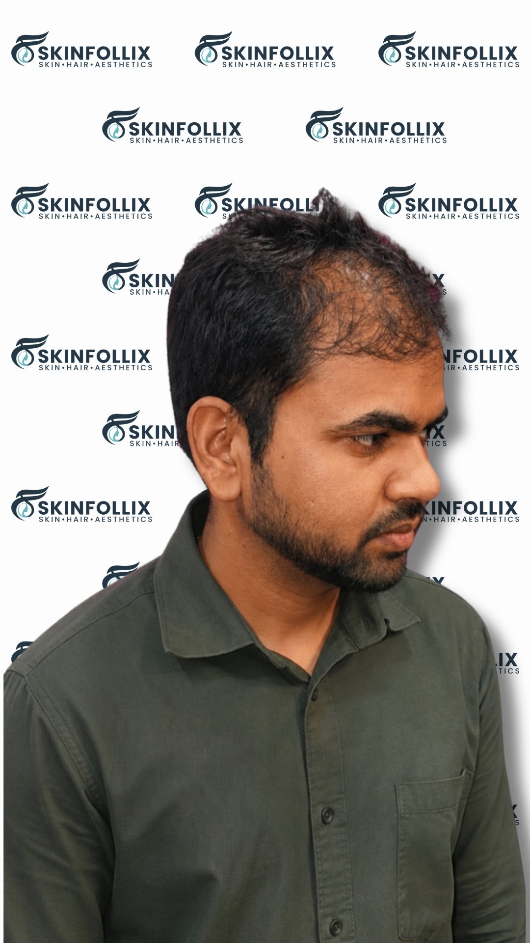 Before hair regrowth treatment at Skinfollix in Delhi