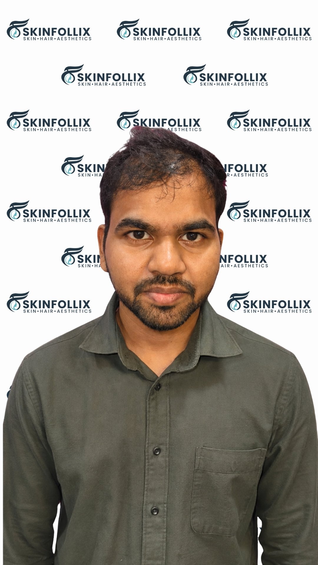 Before hair regrowth treatment at Skinfollix in Delhi