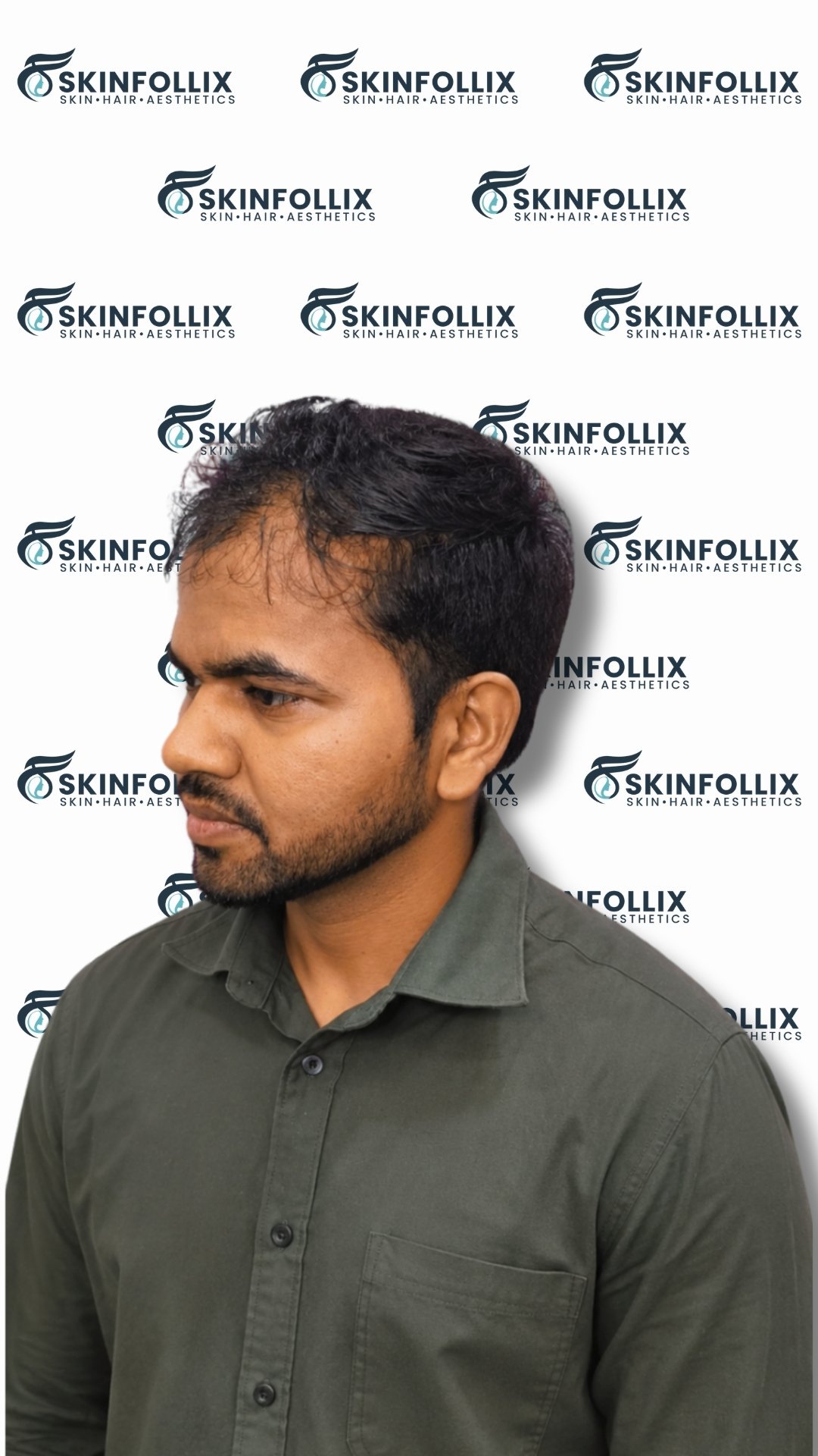 Before hair regrowth treatment at Skinfollix in Delhi