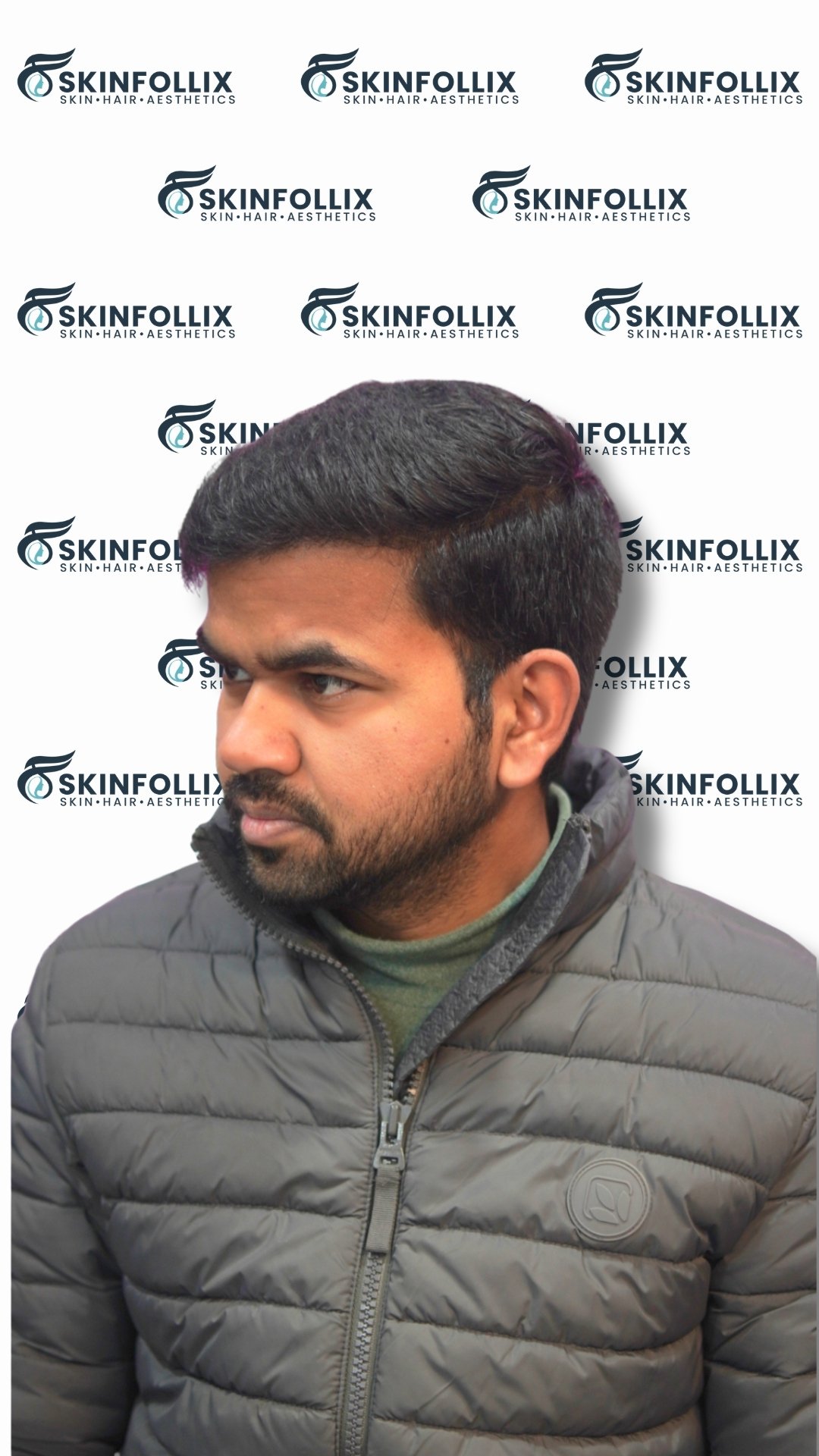 After hair regrowth treatment at Skinfollix in Delhi