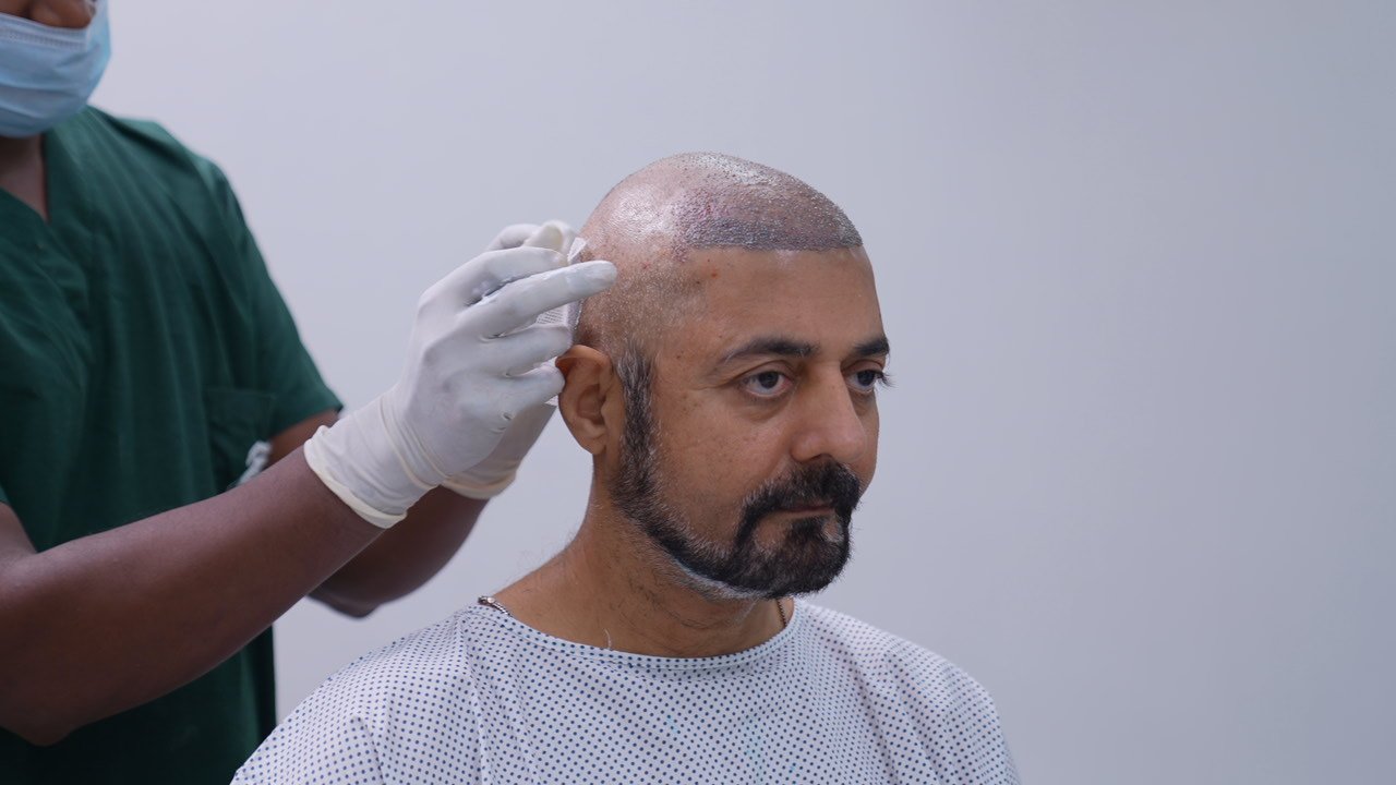 Non shaven hair transplant in Delhi at Skinfollix