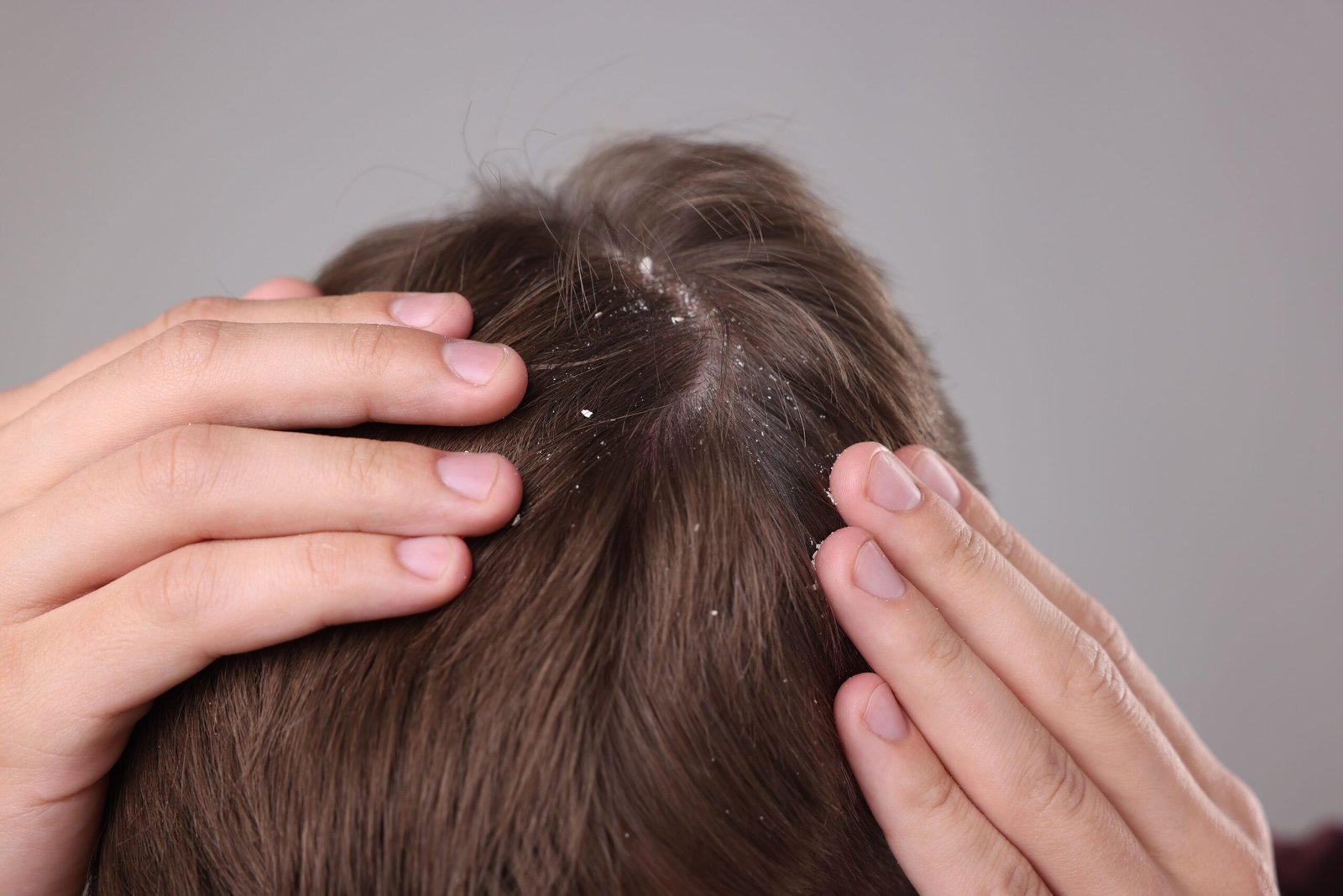 patient consulting a dermatologist in Delhi about persistent dandruff and scalp irritation