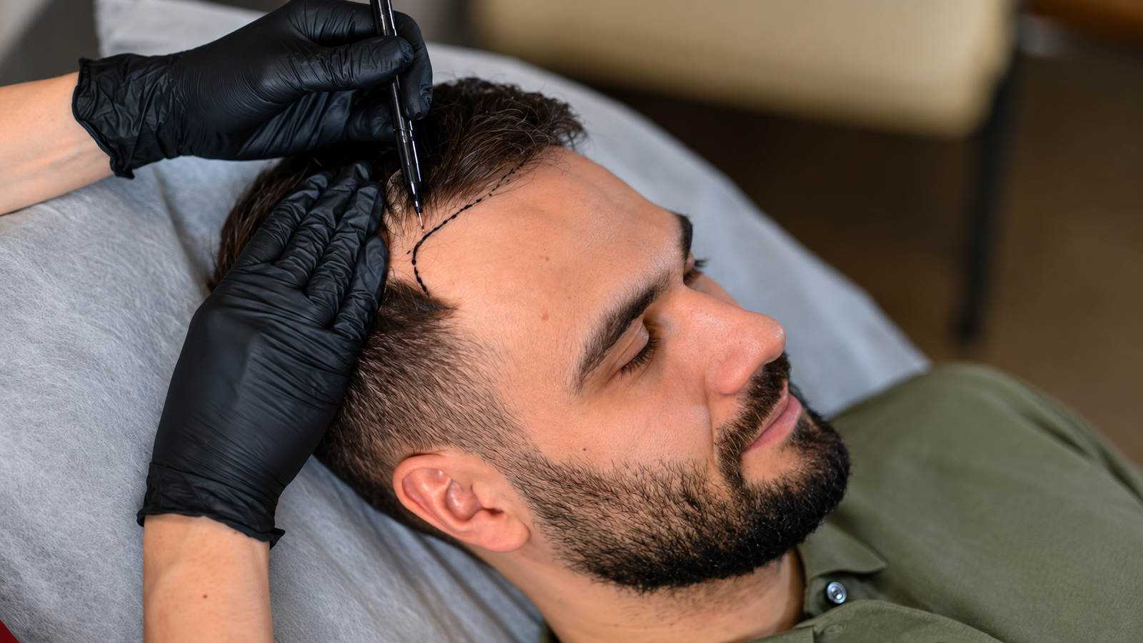 Hair Transplant Clinic in Paschim Vihar