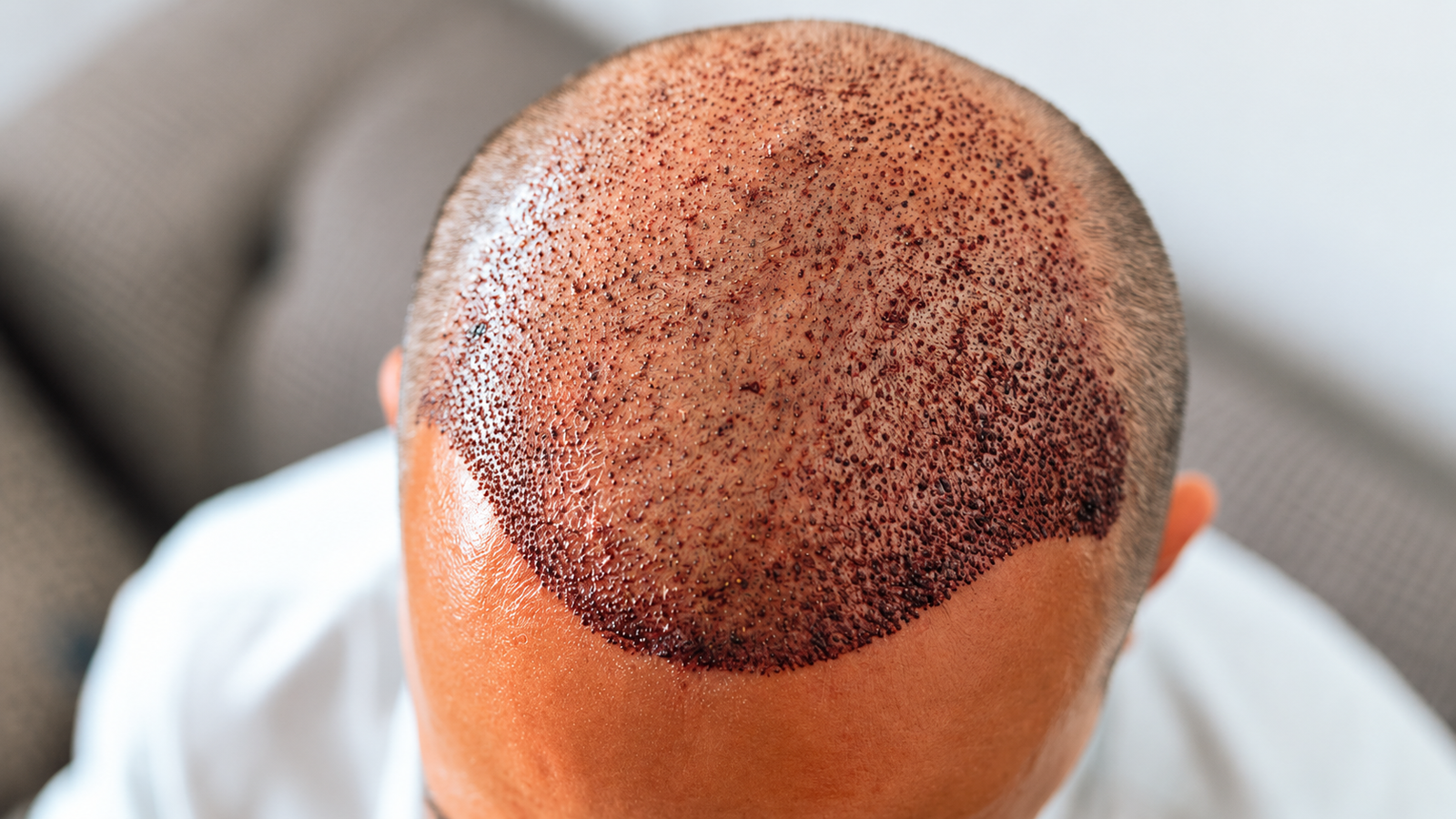 Hair transplant in Paschim Vihar at Skinfollix